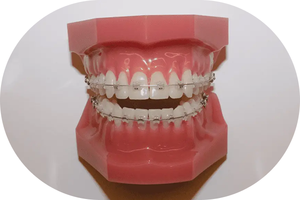 ワイヤー矯正（表側）