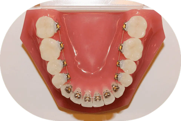 ワイヤー矯正（裏側）