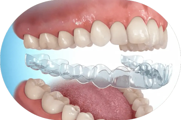 ワマウスピース矯正