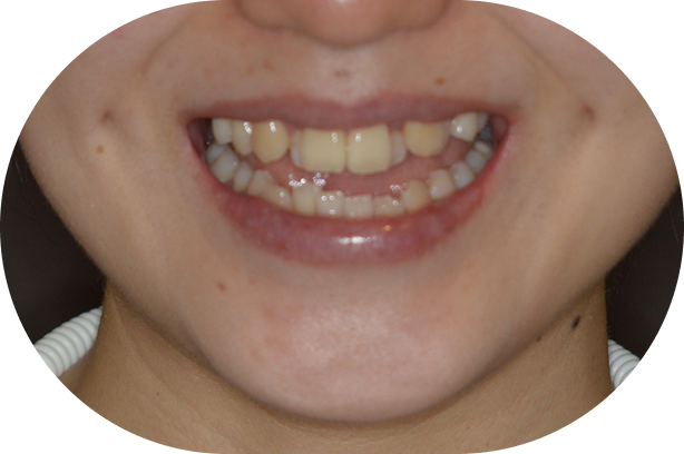 顎変形症に対する矯正