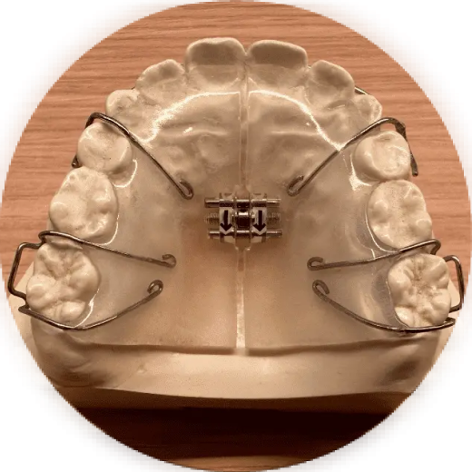 拡大床装置（緩徐拡大装置）